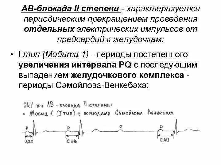 Атриовентрикулярная блокада II степени Мобитц Тип 2 характеризуется:. Са блокада II степени 1 типа. Блокада типа Мобитц 2 характеризуется. Синоатриальная блокада 2 степени типа Мобитц 1. Са блокада степени