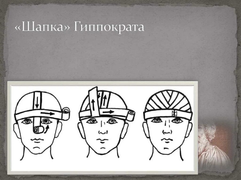 Повязка шапочка гиппократа техника наложения. Схема наложения повязки шапка Гиппократа. Шапочка Гиппократа техника. Перевязка головы шапочка Гиппократа. Шапочка Гиппократа концовка.