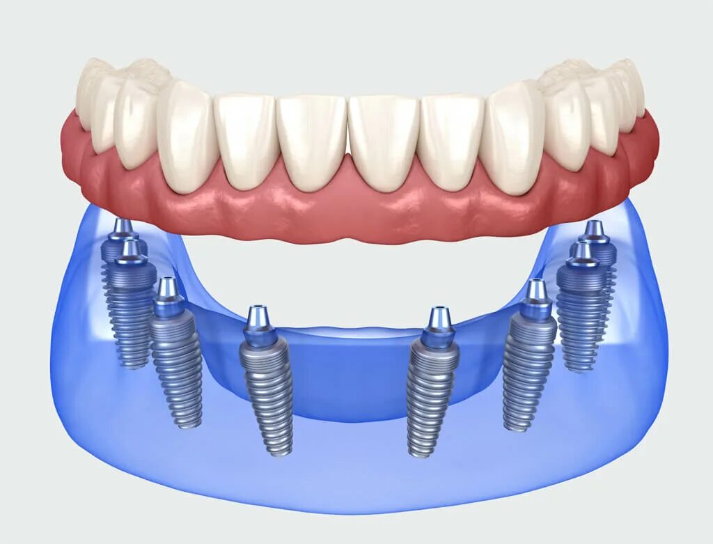 Имплантация челюсти на 6 имплантах. Имплантация всей челюсти all on 4. Имплантация зубов all on 6