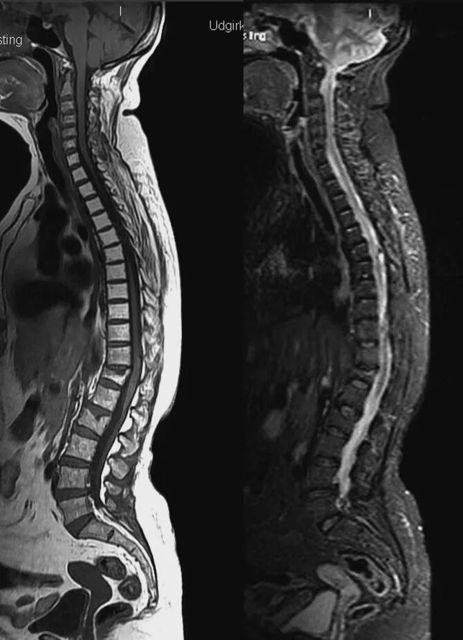 Кт пояснично-крестцового отдела позвоночника норма. РКТ позвоночника. Мрт спинного мозга т1 и т2. Рентгенографию (кт, мрт) позвоночника.