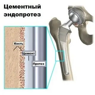 Цементное эндопротезирование тазобедренного сустава