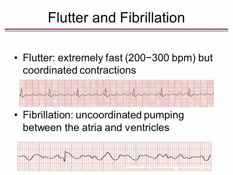 Ventricular Fibrillation. Ventricular Flutter Fibrillation. Difference between ventricular Fibrillation and Flutter ECG. Flutter Cord. Flutter dio