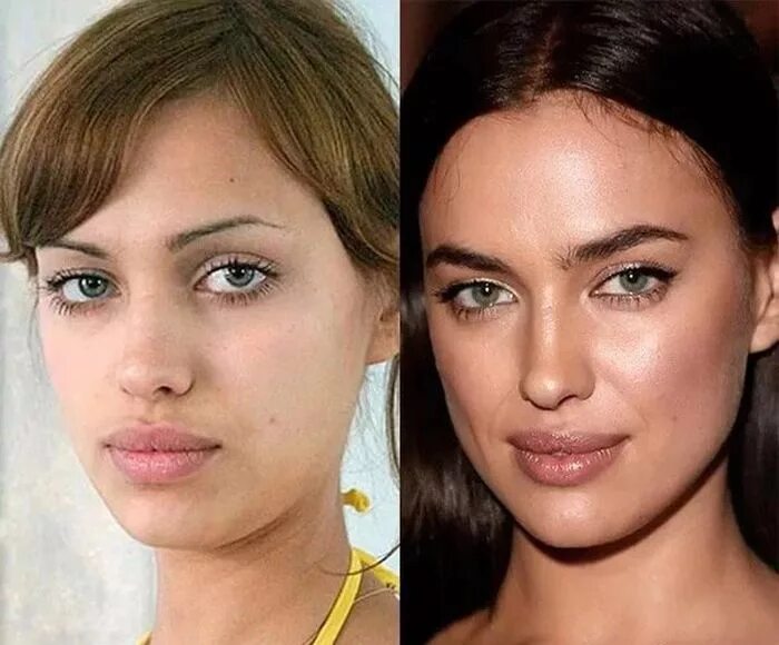 Какую пластику делать
