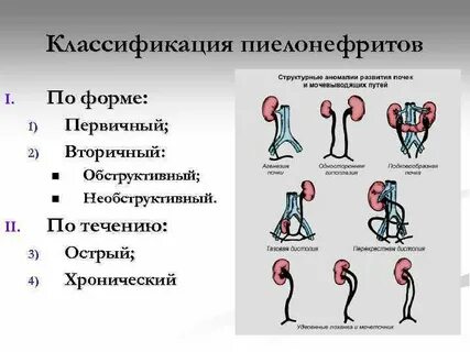 Формы пиелонефрита