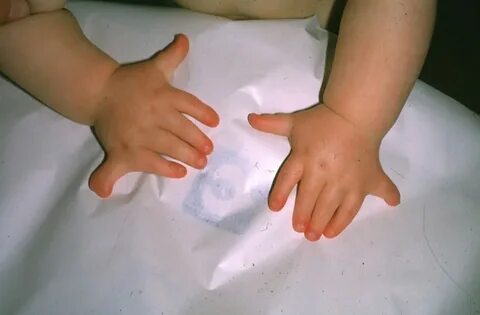 Родился без кисти