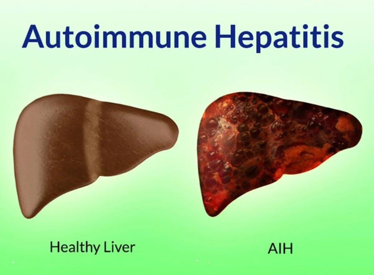 Аутоиммунная печени. Хронический гепатит печень. Здоровая печень и гепатит. Печень больного гепатитом с.