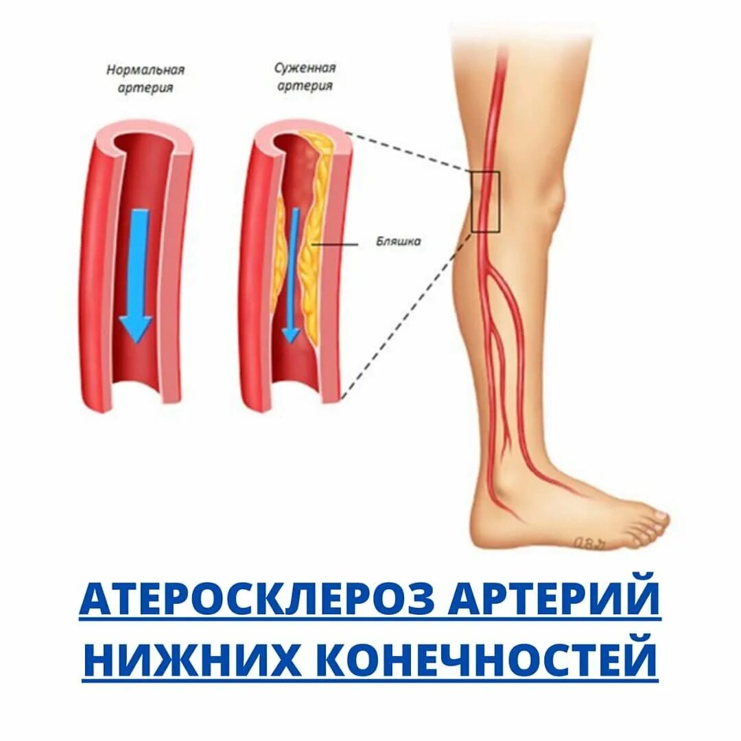 Облитерирующего атеросклероза сосудов конечности. Облитерирующий атеросклероз вен нижних конечностей. облитерирующий атеросклероз сосудов ног. облитерирующие поражения сосудов конечностей. ангиопластика сосудов конечностей.