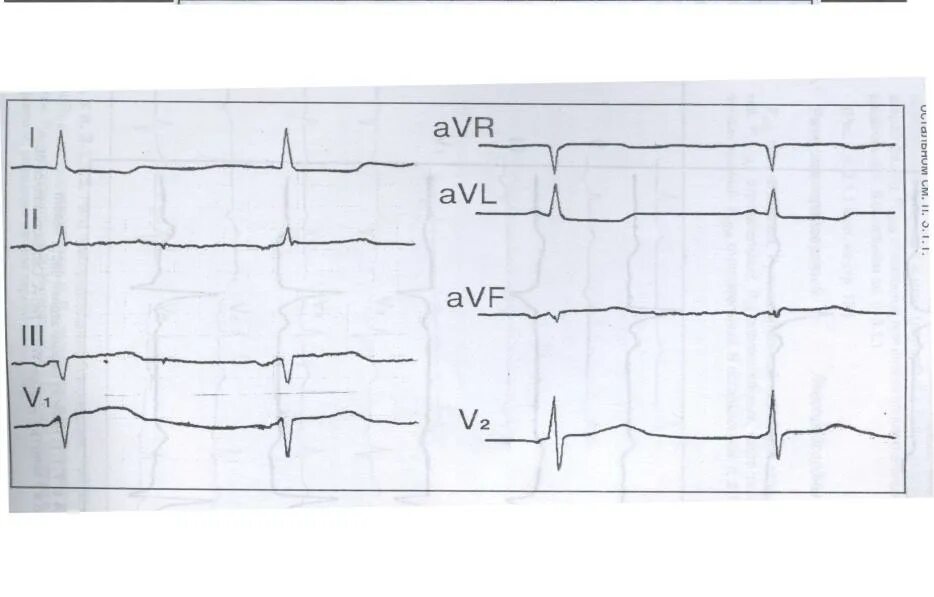 AVR AVL AVF отведения на ЭКГ норма. ЭКГ зубец r в AVR. AVL AVF В ЭКГ. Норма ЭКГ В v1-v2. Отведение v1 на экг