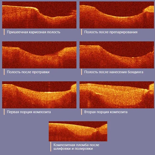 кератопластика роговицы глаза. макулярный разрыв сетчатки ост. пахиметрия норма толщины роговицы. когерентная томография сетчатки глаза норма. сквозная кератопластика этапы.