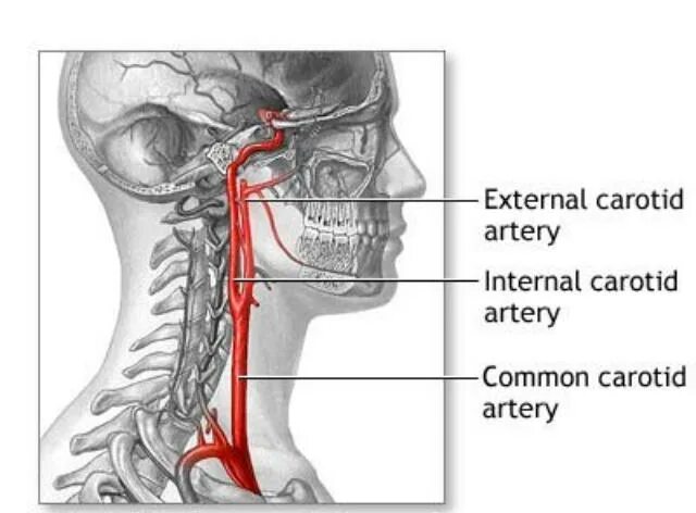 Внутренняя Сонная артерия на шее. Аневризма сонной артерии. Общая сонная артерия находится