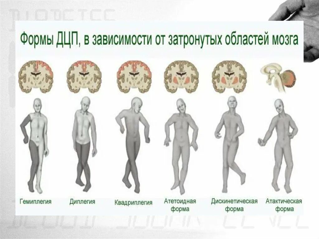 Дцп передается по наследству. Атаксическая форма ДЦП. Дискинетический церебральный паралич у детей. Атактическая форма ДЦП симптомы. Атактическая форма ДЦП симптомы у детей.