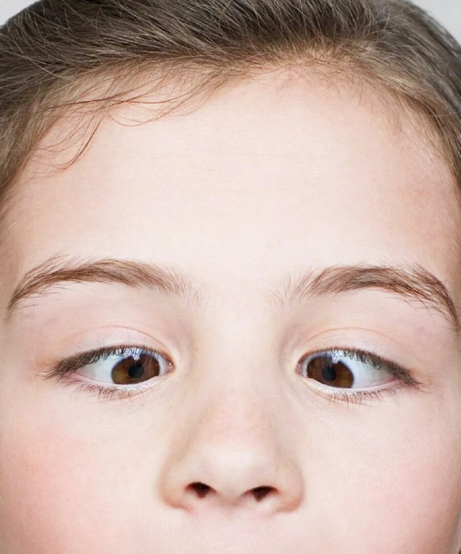Ребенок косит глазки. Косоглазие у детей. Сходящееся косоглазие. Косые глаза. Раскосые глаза у ребенка.