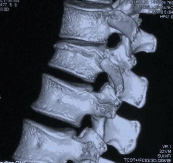 Компрессионный перелом тела th12, l1, l2. Компрессионный перелом позвоночника l12. Компрессионный перелом th12 l2 позвонков. Компрессионный перелом тела 1 1