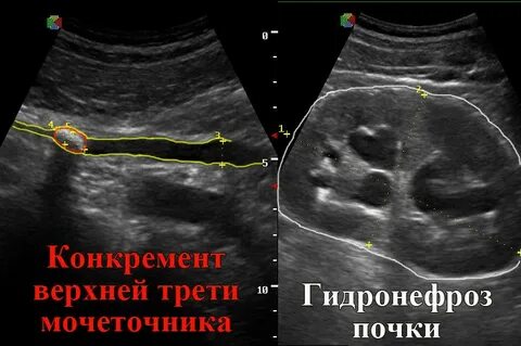 Песок в почках на узи