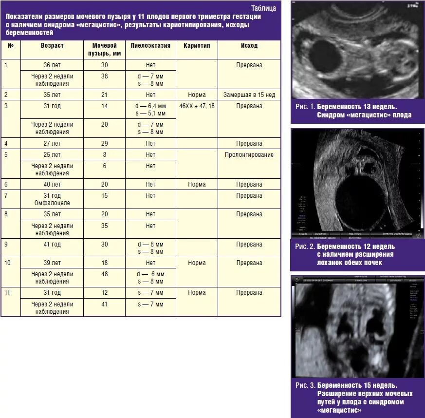 Лоханки при беременности. Объем мочевого пузыря у плода по неделям беременности. Размер мочевого пузыря у плода 12 недель норма таблица. Толщина стенки мочевого пузыря УЗИ. Размеры мочевого пузыря на УЗИ В норме.