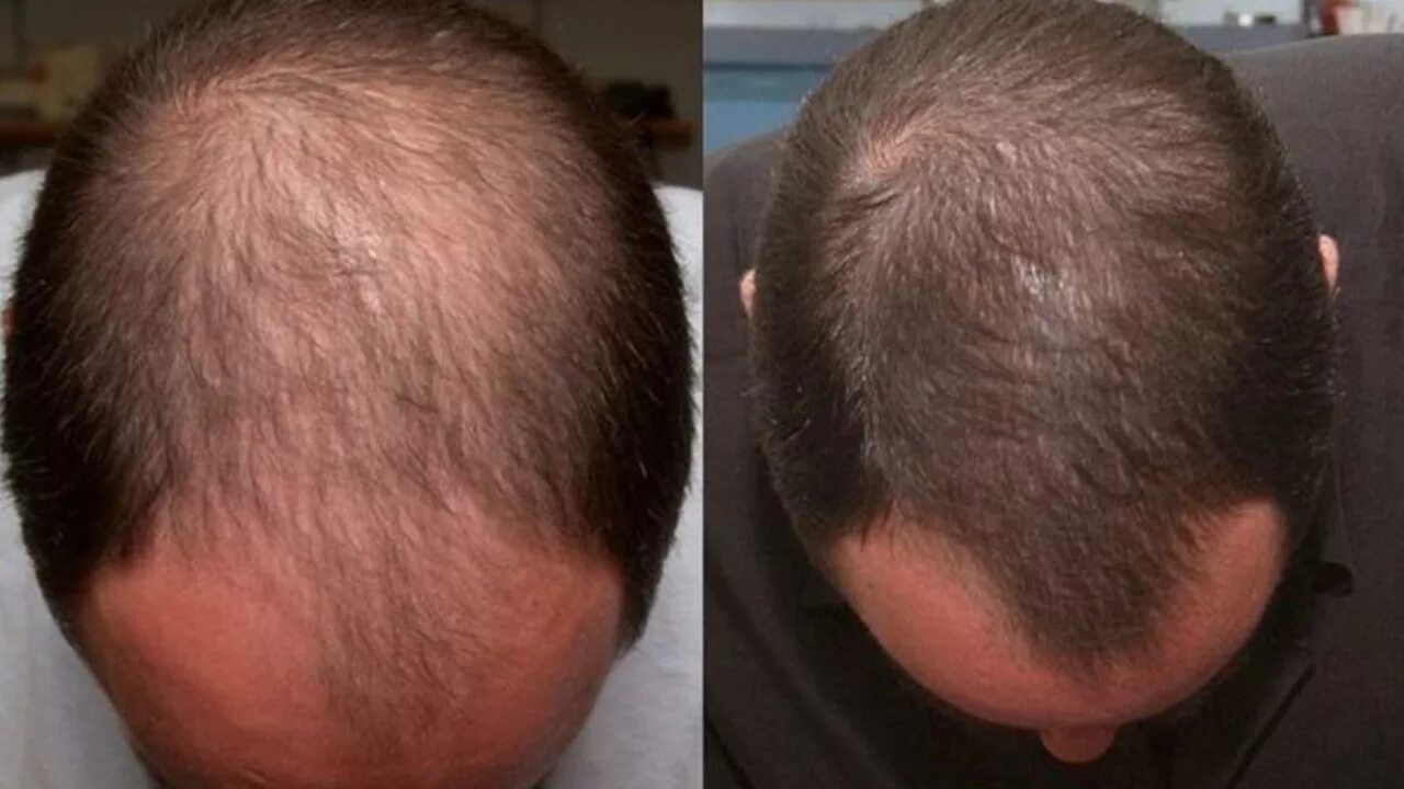 Генеролон миноксидил 5 для бороды. Андрогенная алопеция миноксидил. Миноксидил для волос для мужчин для головы. Андрогенная алопеция алопеция. Волосы выпадают после лечения