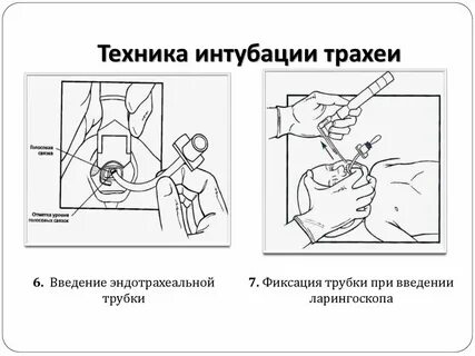 Интубация трахеи дети