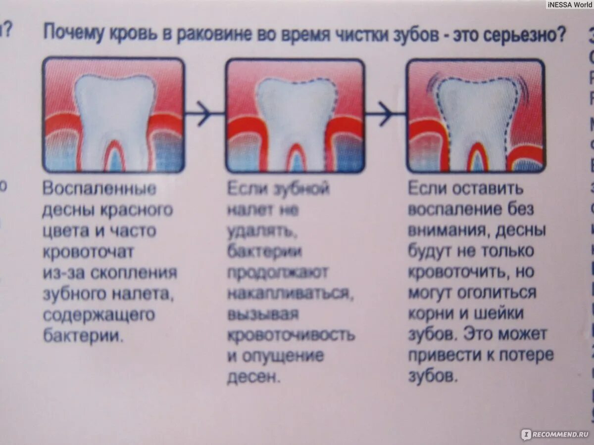 Почему кровь из зубов. Кровоточивость при чистке зубов.