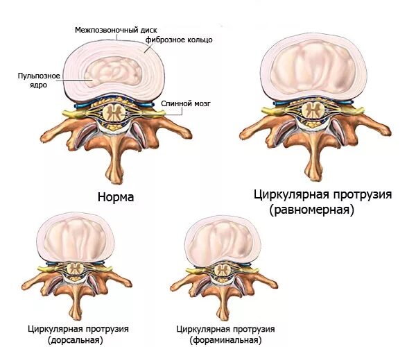 Медианно парамедианная билатеральная. Задняя циркулярная протрузия диска l5-s1. Циркулярное выбухание диска l4/l5.. Циркулярная протрузия межпозвонкового диска l3-l4. Циркулярная протрузия межпозвонкового диска l4-l5.