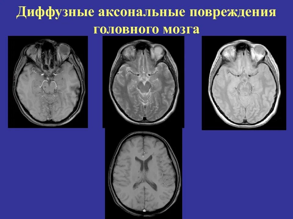 Диффузное аксональное повреждение мозга. Аксональные повреждения головного мозга. Диффузное повреждение головного мозга. Диффузно аксональные повреждения головного мозга. Диффузные аксональные повреждения головного мозга мрт.