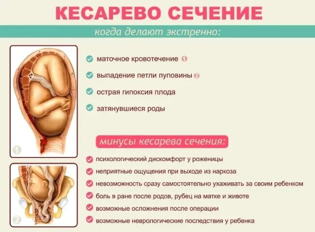 Гестацмонныйссахарный диабет. Кесарево сечение схема. Показания для госпитализации в дородовое отделение. Госпитализация в 40 недель. Ведение родов при сахарном диабете.