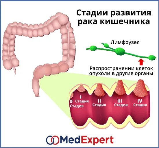 Злокачественная опухоль кишечника. Раковая опухоль кишечника.