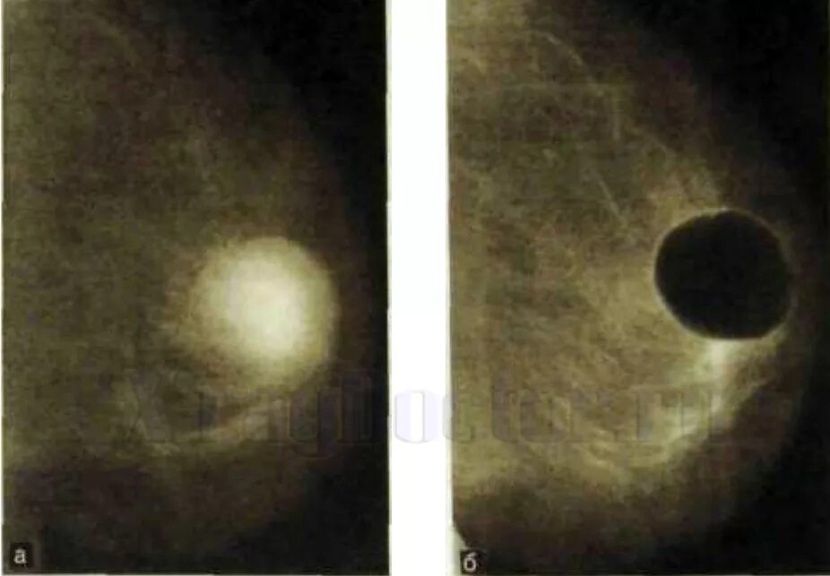 субареолярная киста молочной железы. субареолярный абсцесс. пункция кисты молочных желез. листовидная фиброаденома на маммографии. ретенционные кисты молочной железы.