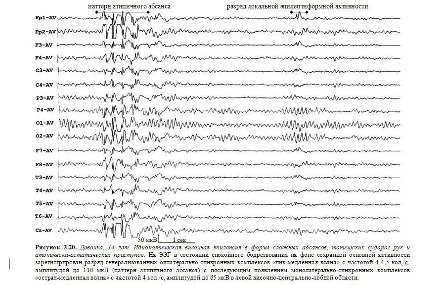 Активность ээг у ребенка что это. Эпилептиформная активность на ЭЭГ. Паттерн абсанса на ЭЭГ. Спайк волна на ЭЭГ. ЭЭГ спайки и острые волны.
