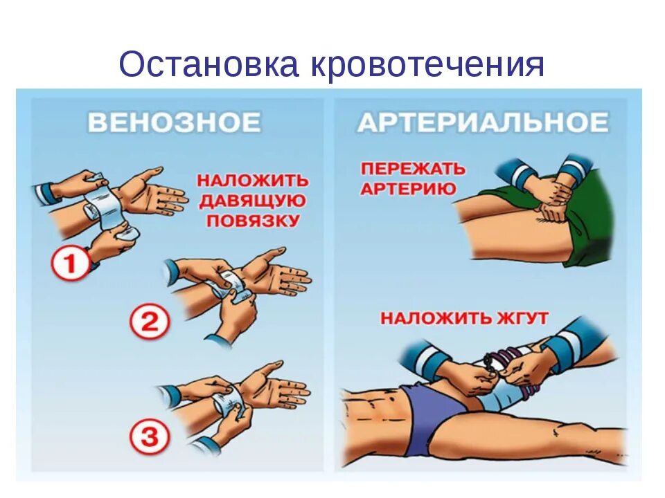 Оказание первой помощи остановки наружного кровотечения. Остановка кровотечения. остановкакровотеечния. способы остановки кровотечения. остановка венозного кровотечения.