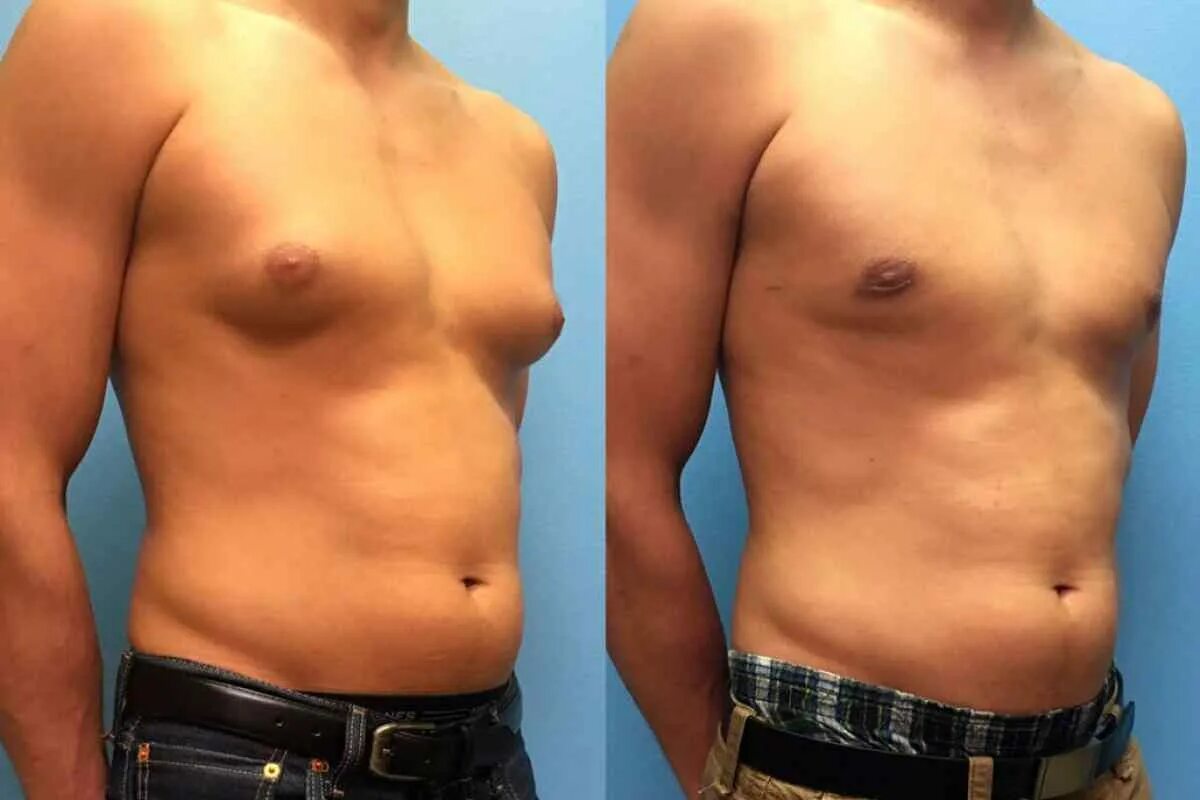 Воронкообразная деформация грудной клетки. Эктоморф гинекомастия. Гинекомастия у подростков 12-15. Эстрадиоловая гинекомастия. Пубертатная гинекомастия.