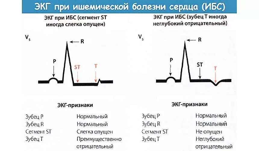 Сегмент St на ЭКГ В норме и патологии. Изменения на ЭКГ при ишемической болезни сердца. Двухфазный зубец т на ЭКГ. Ишемическая болезнь сердца ЭКГ признаки. Перегрузка на экг что это