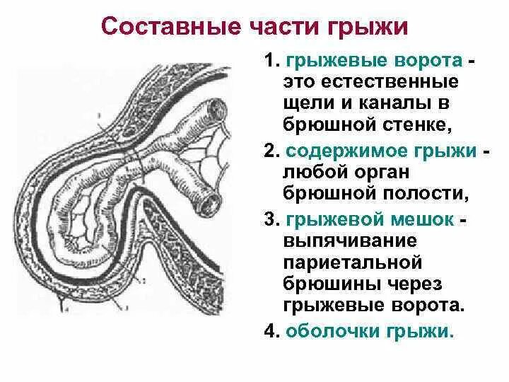 Ущемленная брюшной грыжа. Схема строения наружной грыжи живота. Составные элементы грыжи. Грыжевой мешок строение. Структурная анатомия грыжи.