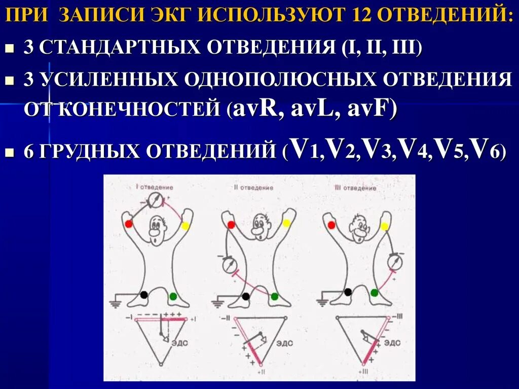 Усиленные однополюсные отведения. ЭКГ во 2 стандартном отведении. 3 Стандартное отведение ЭКГ. Однополюсные отведения ЭКГ. Отведение v1 на экг