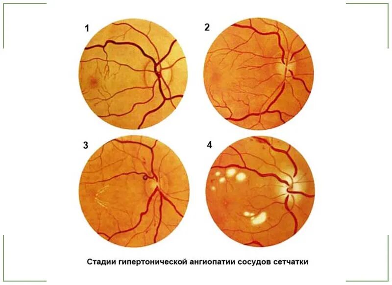 Изменение на глазном дне. Диабетическая ретинопатия глазное дно. Патанатомия диабетической ретинопатии. Диабетическая ретинопатия изменения глазного дна. Дислипидемия ангиопатия сетчатки.