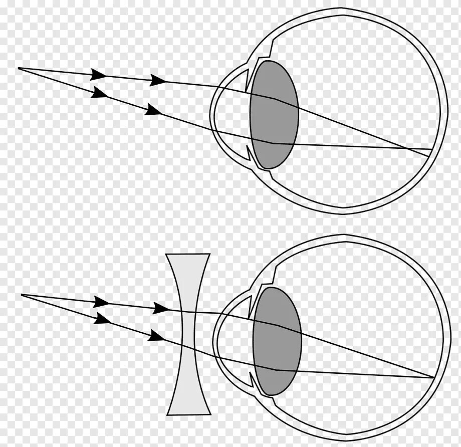 Дальнозоркость линзы двояковыпуклые. Близорукость дальнозоркость астигматизм. Астигматизм схема глаза. Миопия схема глаза. Гиперметропия схема глаза.