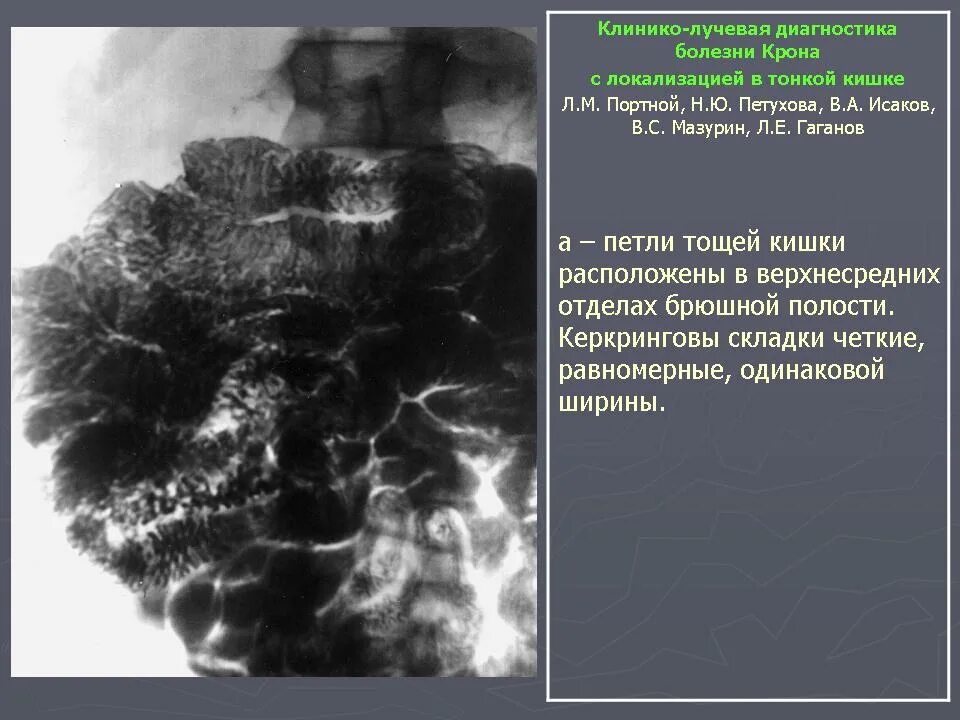 Инструментальное исследование болезнь крона. Болезнь крона рентгенодиагностика. Болезнь крона тощей кишки.