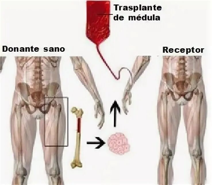Трансплантация костного мозга. Трансплантация клеток костного мозга. Донорский костный мозг. Аллогенная трансплантация костного мозга. Пересадка кости