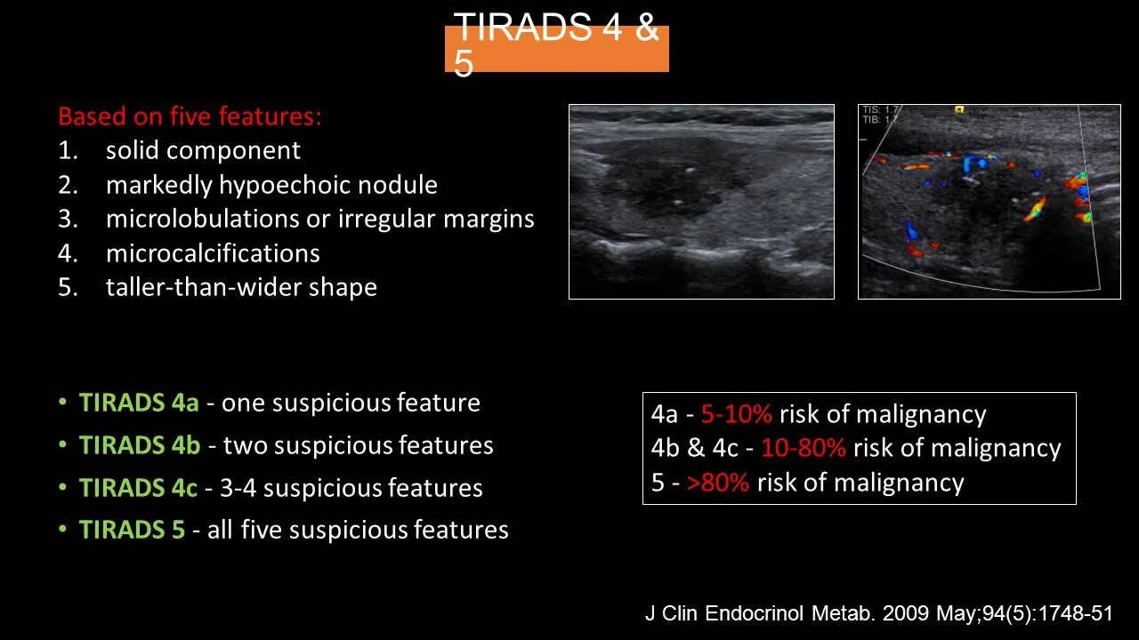 Ti rads что это значит. Tirads 3 щитовидная железа. Шкала тирадс для УЗИ щитовидной железы. Tirads классификация узлов щитовидной железы УЗИ. Узел щитовидной железы Tirads 4.