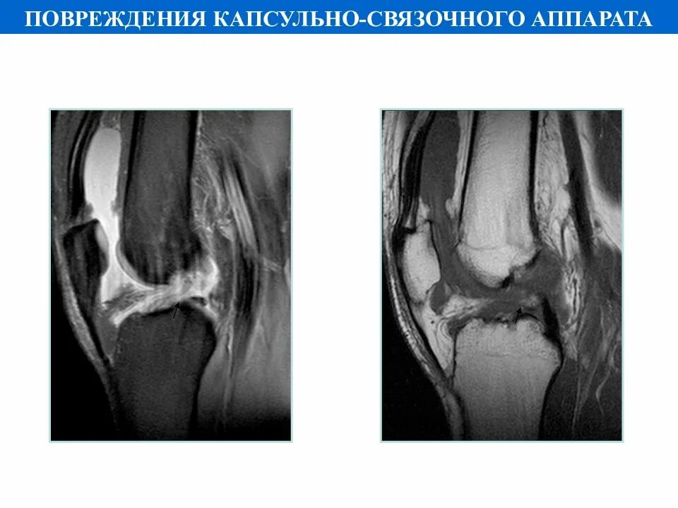 Разрыв пики. Разрыв капсульно связочного аппарата. Закрытая травма капсульно связочного аппарата локтевого сустава. Повреждение капсульно-связочного аппарата коленного сустава. Частичное повреждение капсульно-связочного аппарата.