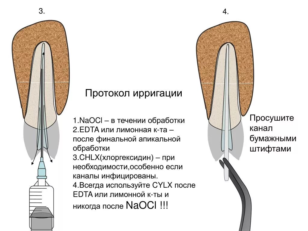Протокол мед обработки корневых каналов. Ирригация корневых каналов в эндодонтии. Ультразвуковые насадки для ретроградного пломбирования. Протокол промывания корневых каналов.