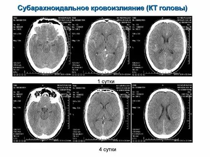 Субарахноидальное кровоизлияние головного