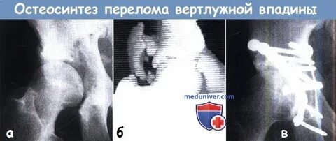 Лечение перелома вертлужной впадины