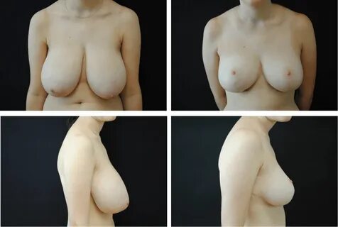 Breast Reduction Case 98109.