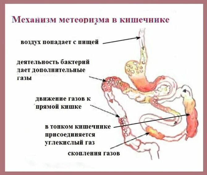 Метеоризм симптомы. Кишечник и вздутие живота. Вздутие кишечника и газообразование. Упражнения для кишечника при вздутии. Газообразование в кишечнике вздутие живота.