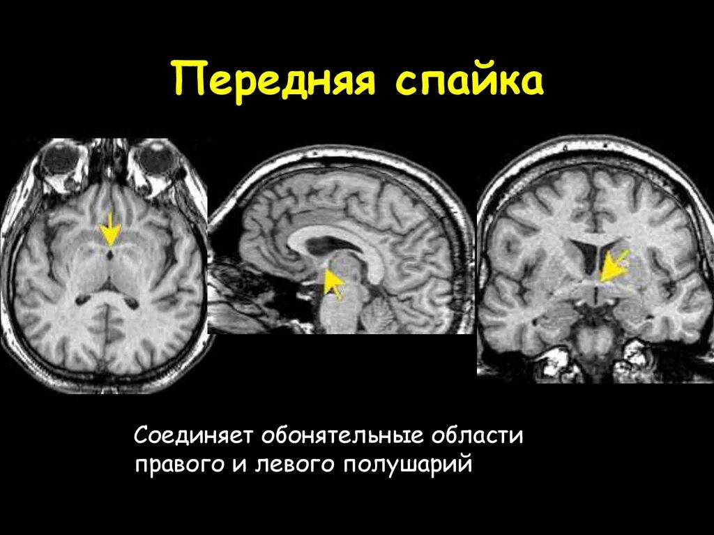 Спайки головного мозга