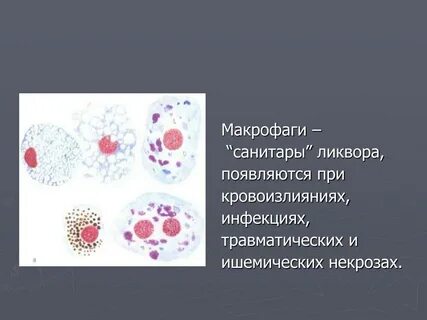 Макрофаги с гемосидерином