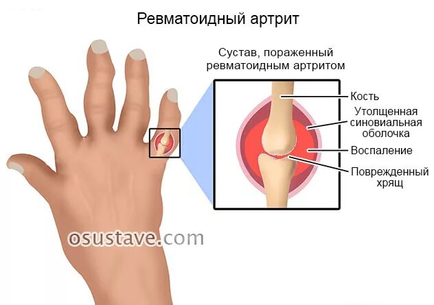 Ревматолог какие заболевания. Ревматоидный артрит синовиальная жидкость. Ревматоидный артрит полиартрит. Ревматоидный артрит полиартрит клиника. Изменения в суставах характерные для ревматоидного артрита рис 152.