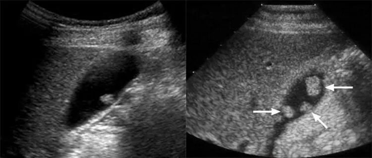 Сгустки в желчном пузыре. Холестериновый полип желчного пузыря кт. Объемное образование желчного пузыря УЗИ. Полип желчного пузыря на УЗИ. Карцинома желчного пузыря УЗИ.