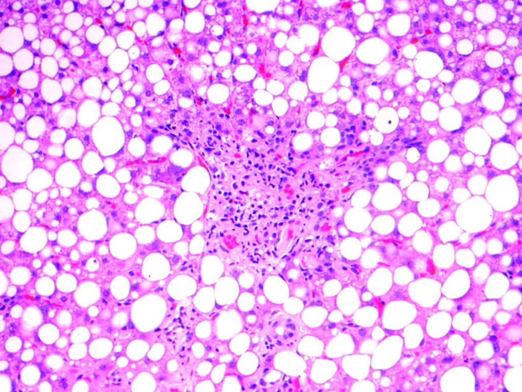 Неалкогольный стеатогепатит у детей. Стеатоз 3. Стадии жировой дистрофии. Стеатоз 3. Жировая дистрофия печени макропрепарат.