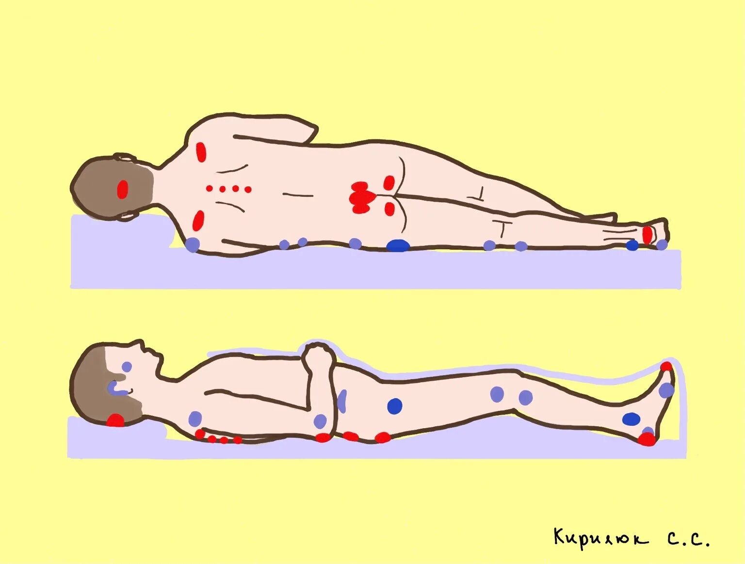 Куда определить лежачего. Пролежни зоны повышенного риска. Места образования пролежней при положении сидя. Положение фаулера в постели. Положение больного фаулера.